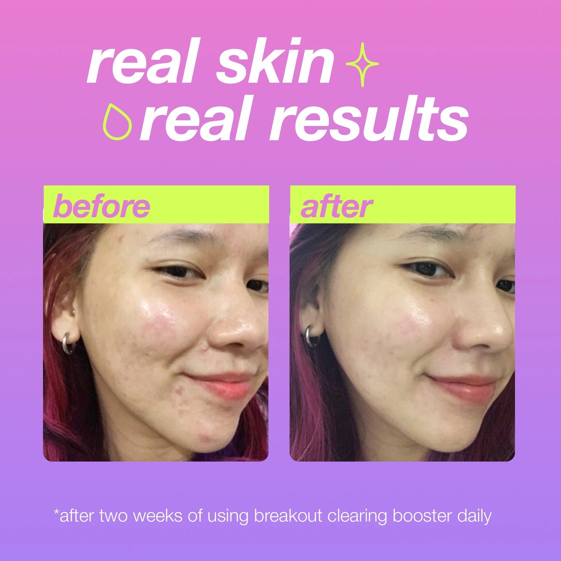 Dermalogica Breakout Clearing Booster 30ml voor effectieve huidverbetering, zichtbaar resultaat voor en na gebruik.