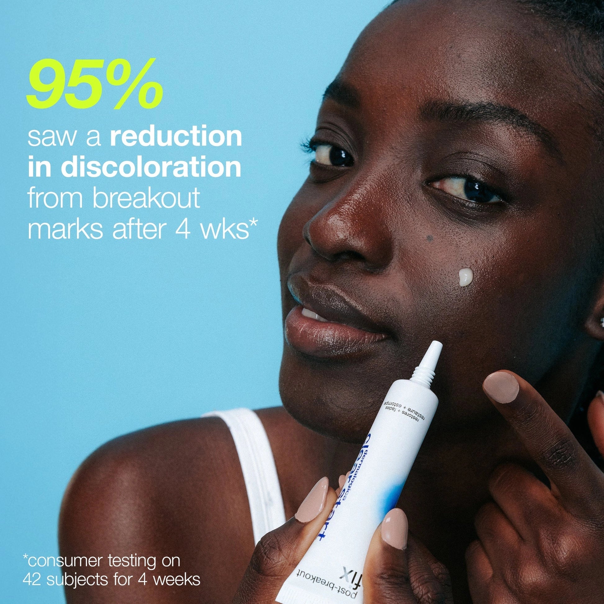 Dermalogica Post-Breakout Fix 15ml op model met de nadruk op verminderde verkleuring van puistjes na 4 weken.