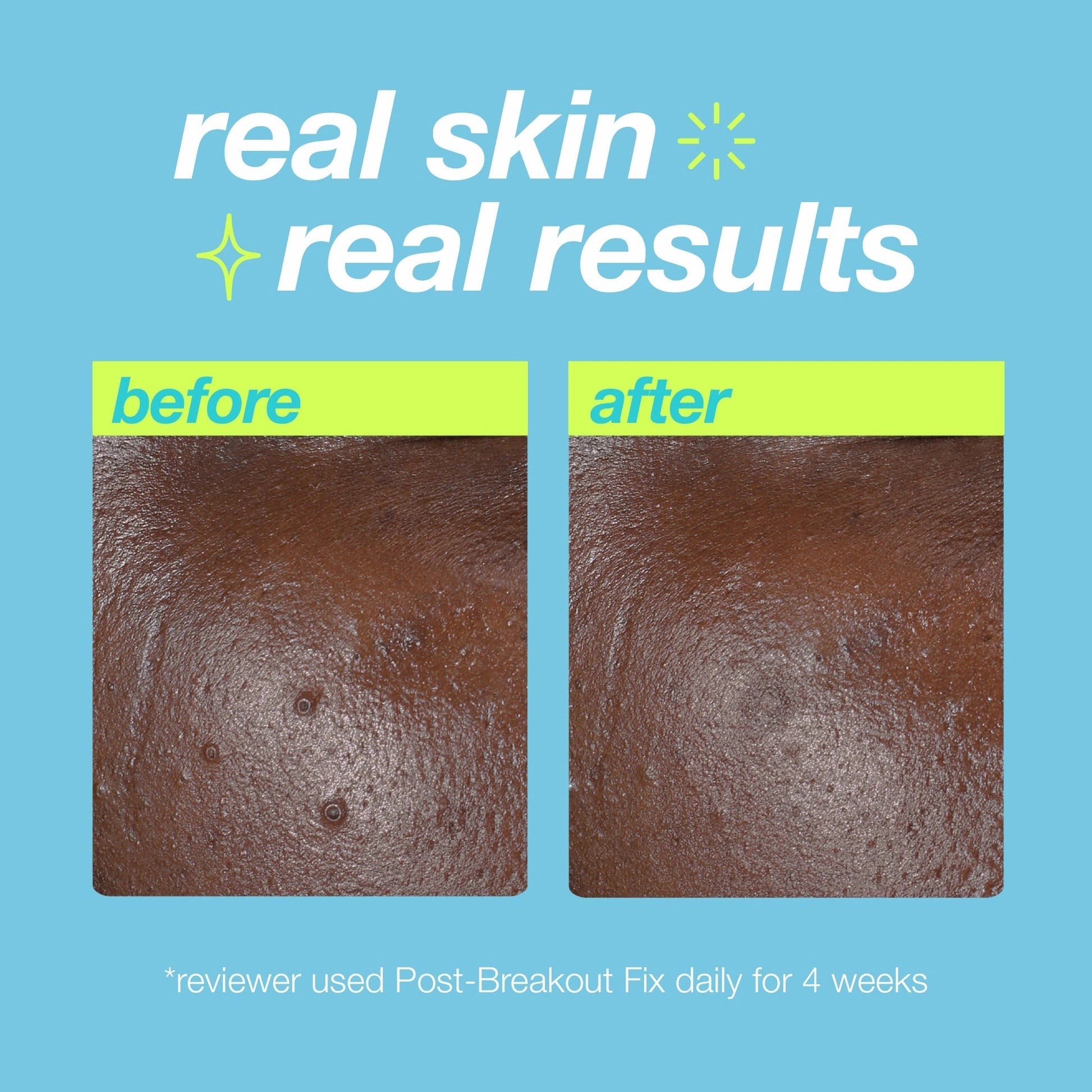 Dermalogica Post-Breakout Fix 15ml voor en na resultaten op huid met PUH vlekken, zichtbaar resultaat na 4 weken.