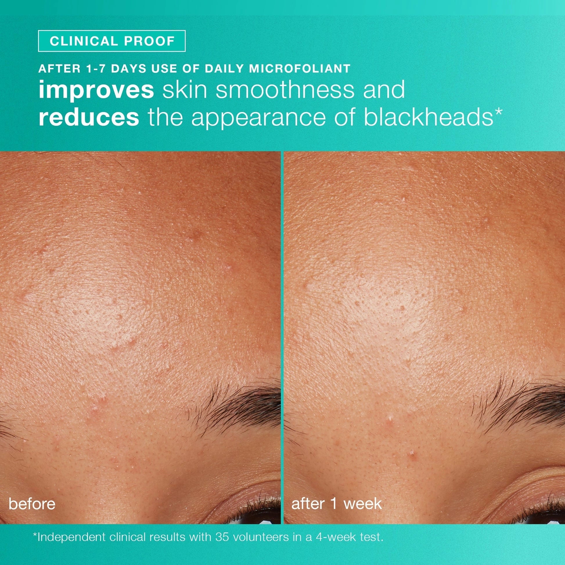 Dermalogica Clear + Brighten Kit 73ml resultaat voor en na gebruik, verbeterde huidtextuur en vermindering van onzuiverheden.