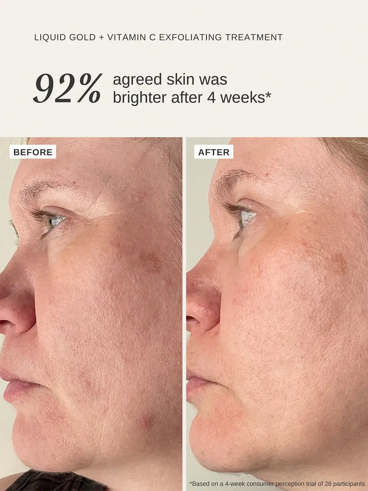 Alpha-H Liquid Gold + Vitamin C 100ml resultaten voor en na behandeling, met zichtbare huidverbetering en helderheid.