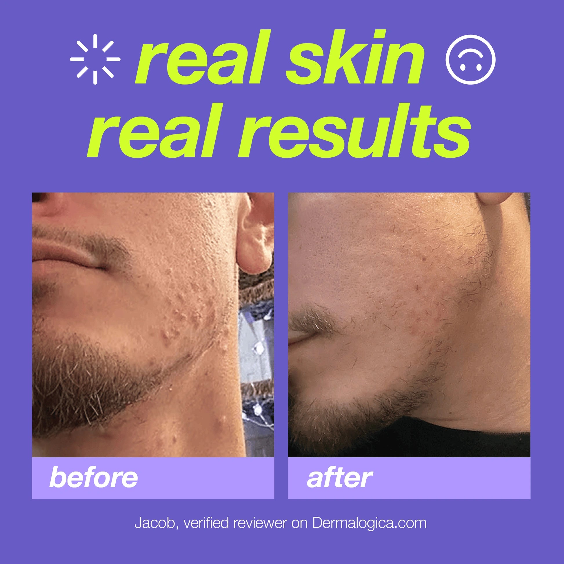 Dermalogica Breakout Clearing Foaming Wash 295ml voor effectieve acnebehandeling, zichtbaar resultaat voor en na gebruik.