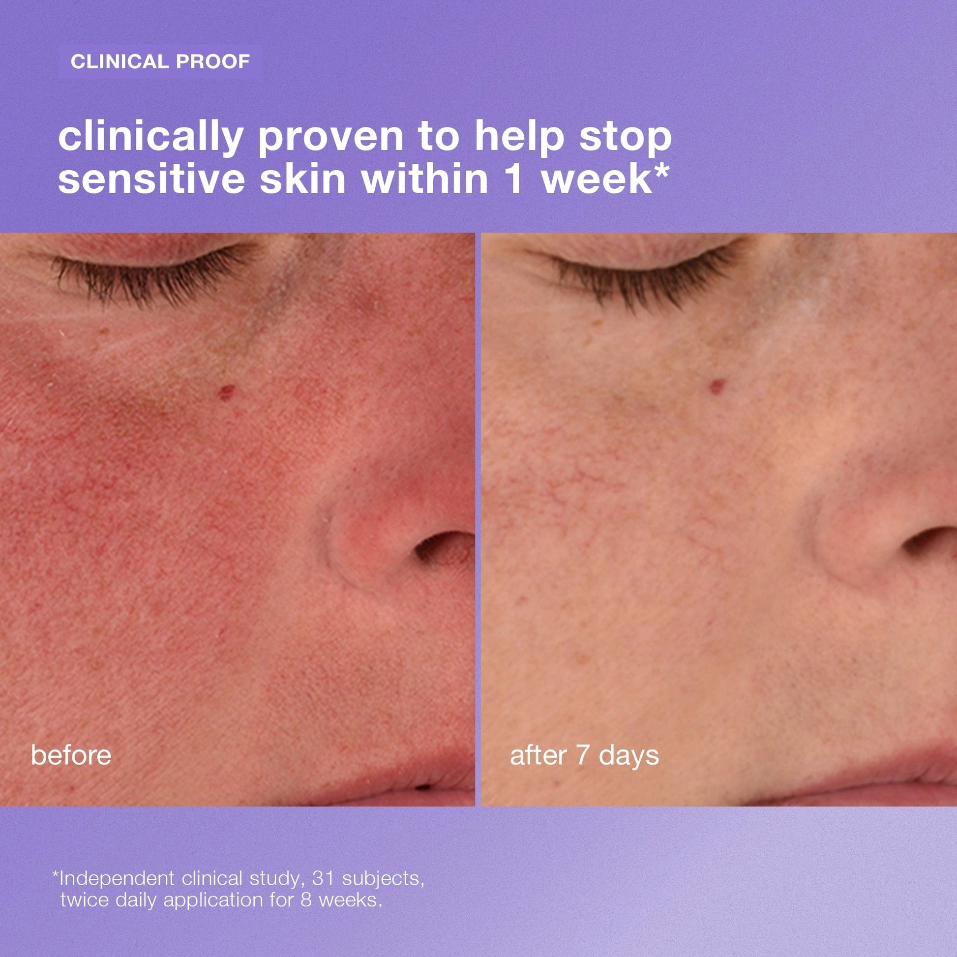 Dermalogica Stabilizing Repair Cream 15ml (travelsize) gevoelige huid voor en na 7 dagen resultaat van klinische studie