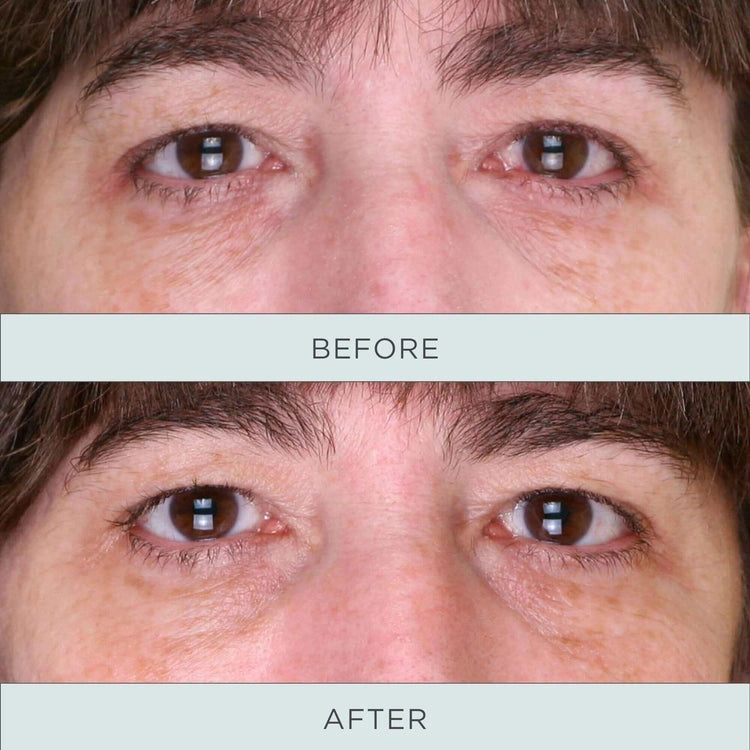 Resultaten van PUR Tone Up Niacinamide Firming Eye Serum 12,5ml vóór en na toepassing met zichtbaar verbeterde huidstructuur rond de ogen.